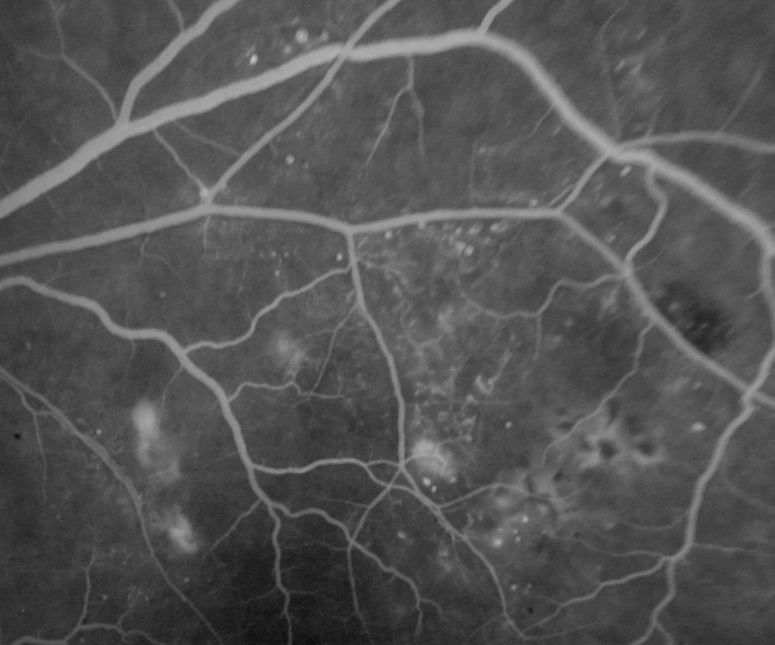 Fluorescein angiogram of diabetic macular edema